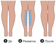 імплантати гомілки