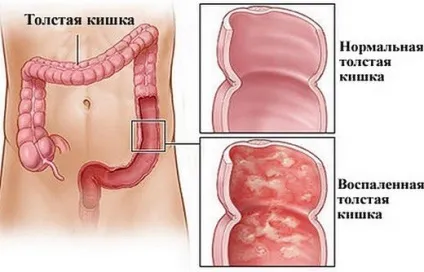 Інфекційний коліт симптоми, лікування інфекційного коліту кишечника (інфекційний) Інфекційний коліт симптоми, лікування інфекційного коліту кишечника