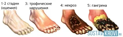 Ішемія нижніх кінцівок причини, симптоми, лікування, ускладнення і профілактика (причини) Ішемія нижніх кінцівок причини, симптоми, лікування, ускладнення і профілактика