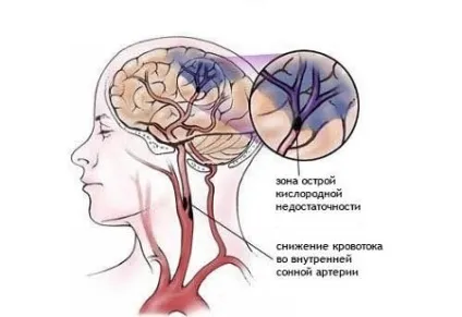 Ішемічний інсульт головного мозку прогноз, наслідки, лікування (прогноз) Ішемічний інсульт головного мозку прогноз, наслідки, лікування