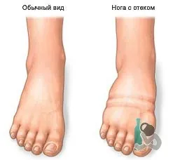 Як швидко зняти набряки після вживання спиртного, як зробити (зняти) Як швидко зняти набряки після вживання спиртного, як зробити