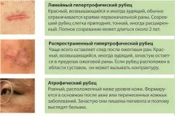 Як і чим лікувати рубці після опіків (після) Як і чим лікувати рубці після опіків
