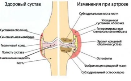 Як лікувати артроз колінного суглоба в домашніх умовах (лікувати) Як лікувати артроз колінного суглоба в домашніх умовах