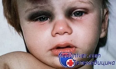 Як знеболити місце забитого у дитини синці і шишки у дітей (як знеболити місце забитого у дитини) Як знеболити місце забитого у дитини синці і шишки у дітей