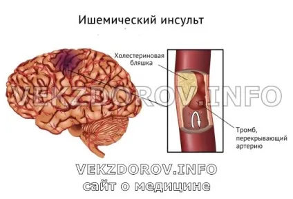 Як правильно поводитися після інсульту, або основні правила реабілітації (після) Як правильно поводитися після інсульту, або основні правила реабілітації