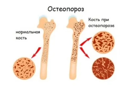 Як приймати яєчну шкаралупу при остеопорозі кісток (щільності кісткових тканин) Як приймати яєчну шкаралупу при остеопорозі кісток