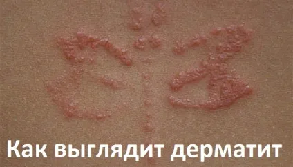 Як виглядає дерматит у дітей (фото) (дерматит) Як виглядає дерматит у дітей (фото)