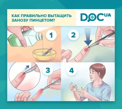 Як витягти скалку безболісно з-під нігтя, руки, ноги, з п'яти у дитини (безболісно) Як витягти скалку безболісно з-під нігтя, руки, ноги, з п'яти у дитини