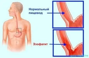 Кандидозний езофагіт - види, причини, симптоми, лікування (причини) Кандидозний езофагіт - види, причини, симптоми, лікування