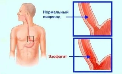 Кандидозний езофагіт причини, симптоми і оптимальне лікування (езофагіт) Кандидозний езофагіт причини, симптоми і оптимальне лікування