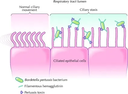 Кашлюк - збудник (bordetella pertussis), епідеміологія захворювання (bordetella) Кашлюк - збудник (bordetella pertussis), епідеміологія захворювання