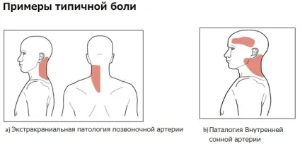 Синдром вертебробазилярной артеріальної системи симптоми і лікування (системи) Синдром вертебробазилярной артеріальної системи симптоми і лікування