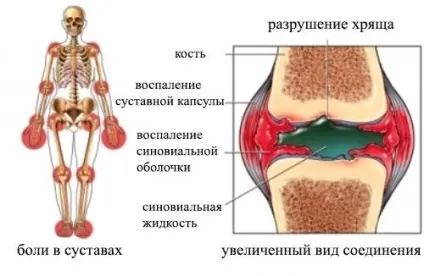 Симптоми і лікування поліартрози (лікування) Симптоми і лікування поліартрози