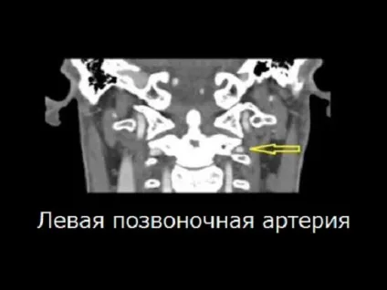 Синдром вертебробазилярной артеріальної системи симптоми і лікування (системи) Синдром вертебробазилярной артеріальної системи симптоми і лікування
