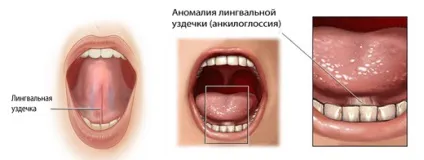Коротка вуздечка мови (скальпель або лазер) (вуздечка) Коротка вуздечка мови (скальпель або лазер)