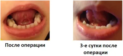 Коротка вуздечка мови (скальпель або лазер) (скальпель) Коротка вуздечка мови (скальпель або лазер)