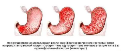 Курс лікування виразки 12-палої кишки від першого симптому (курс) Курс лікування виразки 12-палої кишки від першого симптому