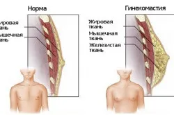 Лікування гінекомастії без операції (жіночих статевих гормонів) Лікування гінекомастії без операції