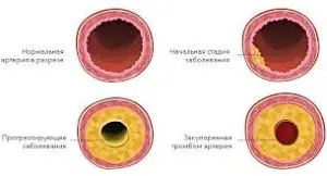 Лікування атеросклерозу травами, світ здоров'я (лікування) Лікування атеросклерозу травами, світ здоров'я