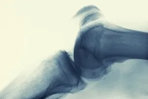 Лікування артрозу колінного суглоба лазером принцип дії