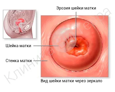 Лікування ерозії шийки матки (лікування) Лікування ерозії шийки матки