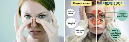 Лікування гаймориту без проколів в домашніх умовах (умовах) Лікування гаймориту без проколів в домашніх умовах
