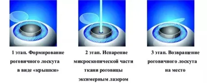 Лазерна корекція астигматизму інновації в лікуванні