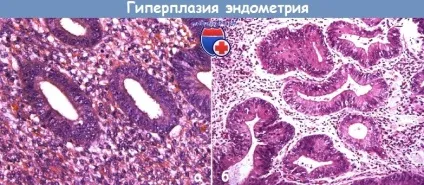 Лікування атипової гіперплазії ендометрія (аге) (ендометрія) Лікування атипової гіперплазії ендометрія (аге)