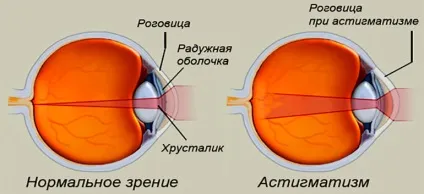 Лікування астигматизму - центр очної хірургії (очна хірургія Київ центр клініка лікування зір очна хірургія хірург очей лікар лазер) Лікування астигматизму - центр очної хірургії