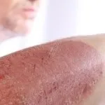 Лікування псоріазу, псоріаз