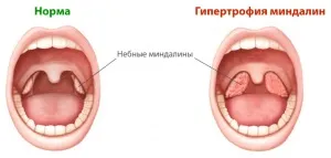Лікування мигдалин лазером деструкція, припікання, абляція (мигдалин) Лікування мигдалин лазером деструкція, припікання, абляція