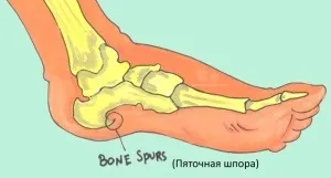 Лікування шпор на п'ятах (лікування болю від шпор при захворюванні п'ят) Лікування шпор на п'ятах