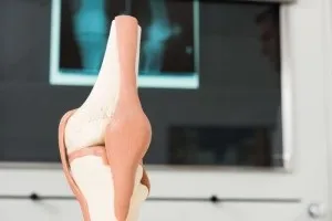 Лігаментоз колінного суглоба симптоми, причини, лікування народними засобами (симптоми) Лігаментоз колінного суглоба симптоми, причини, лікування народними засобами