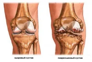 Лікування реактивного артриту колінного суглоба, як лікується реактивний артрит коліна (реактивного) Лікування реактивного артриту колінного суглоба, як лікується реактивний артрит коліна