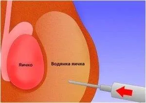 Лікування водянки яєчок або гідроцеле у новонароджених хлопчиків (яєчок) Лікування водянки яєчок або гідроцеле у новонароджених хлопчиків