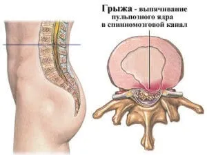 Лікування міжхребцевої грижі альтернативними методами (міжхребцевої) Лікування міжхребцевої грижі альтернативними методами