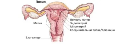 Лікування поліпів в матці народними засобами - методи та відгуки (відгуки) Лікування поліпів в матці народними засобами - методи та відгуки