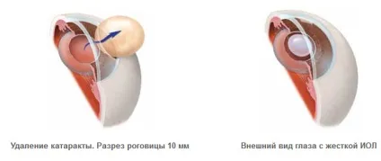 Лікування катаракти факоемульсифікація, видалення - що необхідно знати (лікування) Лікування катаракти факоемульсифікація, видалення - що необхідно знати