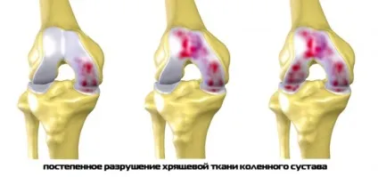 Лікування реактивного артриту колінного суглоба, як лікується реактивний артрит коліна (лікування) Лікування реактивного артриту колінного суглоба, як лікується реактивний артрит коліна