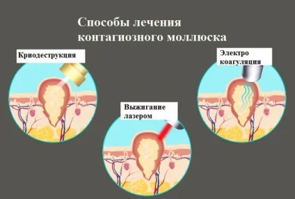 Лікування контагіозного молюска у дитини ознаки, фото (фото) Лікування контагіозного молюска у дитини ознаки, фото