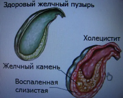 Лікування холециститу народними засобами, цілюща сила рослин (лікування холециститу народними засобами) Лікування холециститу народними засобами, цілюща сила рослин