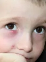 Мішки під очима у дитини