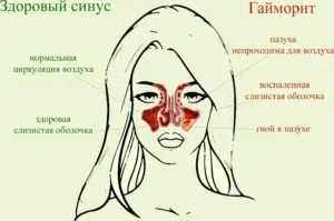 Мед, сода і масло від гаймориту рецепти