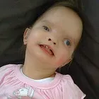 Мікрофтальм - причини, симптоми і лікування (лікування) Мікрофтальм - причини, симптоми і лікування