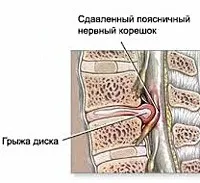 Міжхребцева грижа поперекового відділу - причини, симптоми, діагностика та лікування (грижа) Міжхребцева грижа поперекового відділу - причини, симптоми, діагностика та лікування