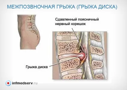 Міжхребцева грижа поперекового відділу симптоми, специфічні і типові прояви грижі (міжхребцева грижа поперековий відділ симптоми ознаки прояву нерв корінець біль хребетний диск) Міжхребцева грижа поперекового відділу симптоми, специфічні і типові прояви грижі