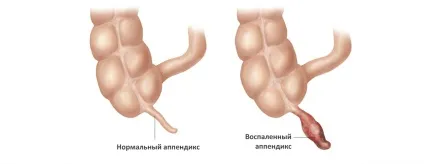 Чи може апендицит хворіти тиждень або місяць (хворіти) Чи може апендицит хворіти тиждень або місяць