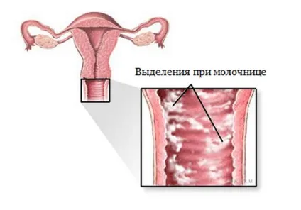 Молочниця у дівчат від чого буває, причини і симптоми (молочниця) Молочниця у дівчат від чого буває, причини і симптоми