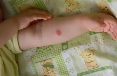 На який день перевіряють манту у дитини через скільки часу і як повинна виглядати (дитини) На який день перевіряють манту у дитини через скільки часу і як повинна виглядати