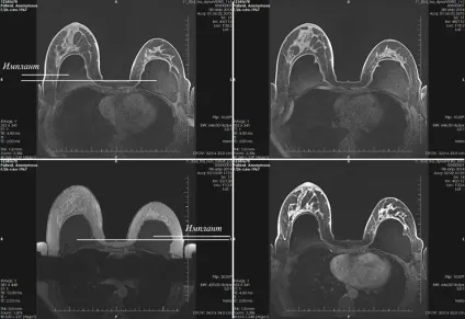 Мрт молочної залози - показання та протипоказання (показання) Мрт молочної залози - показання та протипоказання
